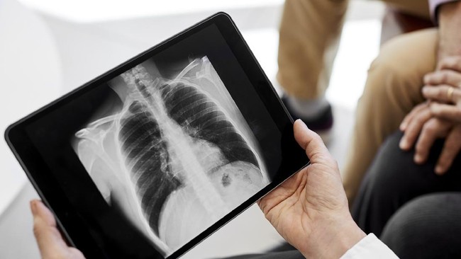 Kebiasaan merokok membuat kondisi paru-paru jauh berbeda dengan paru-paru yang sehat Seperti apa beda paru sehat dan paru perokok?